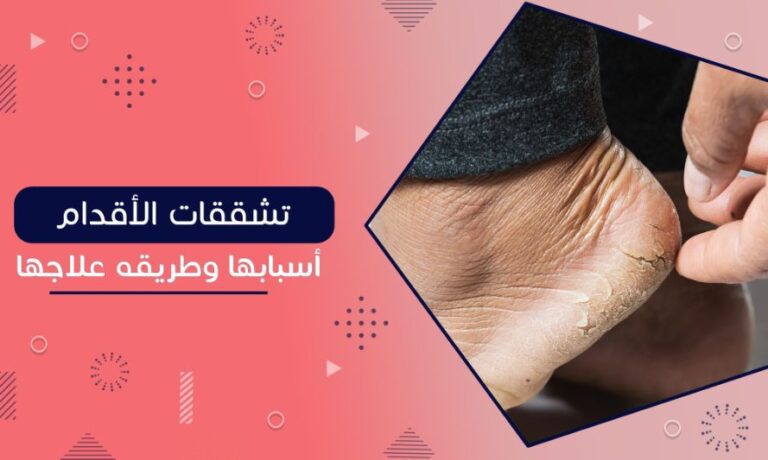 Read more about the article تشققات القدمين أسبابها وعلاجها